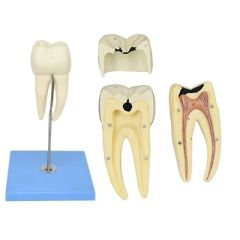 Dente Molar Inferior com Raiz Dupla 