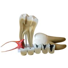 Dente Molar com Cárie